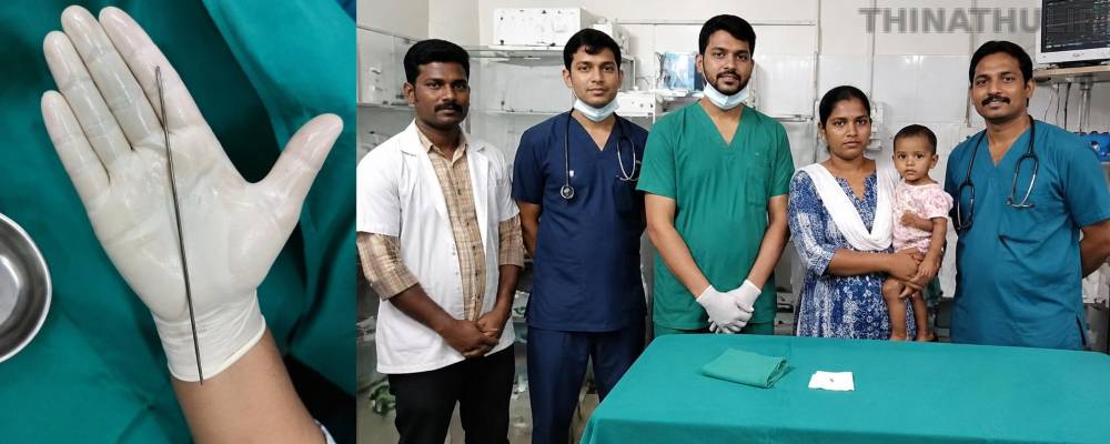 ஈரோட்டில் ஒரு வயது குழந்தையின் தொண்டையில் சிக்கிய இரும்பு கம்பி அகற்றம்: அரசு மருத்துவர்கள் சாதனை